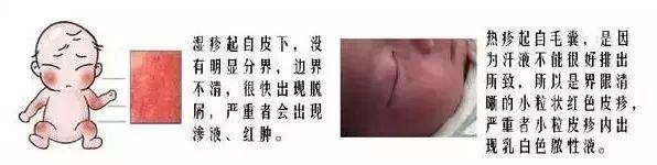【新手妈妈必看】湿疹与热疹的区别、预防和处理？