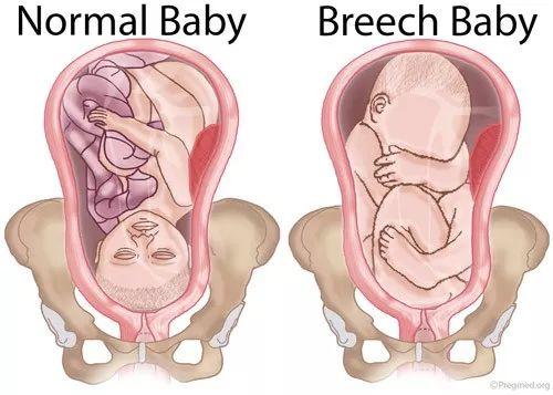 臀位强行顺产，宝宝的头被硬生生扯断了：这不是医疗事故是杀人吧！