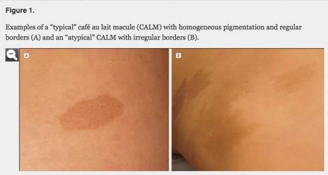 宝宝的胎记都代表什么意思？这样的胎记要留意了！