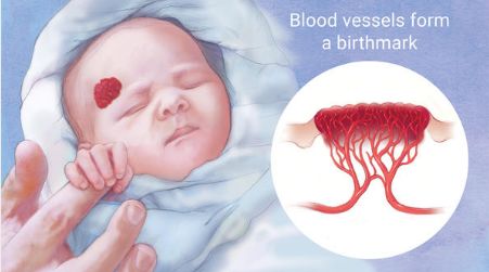 宝宝的胎记都代表什么意思？这样的胎记要留意了！