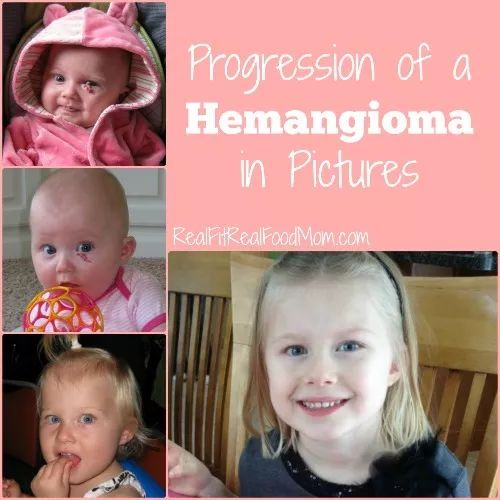 宝宝的胎记都代表什么意思？这样的胎记要留意了！