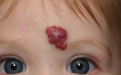 宝宝的胎记都代表什么意思？这样的胎记要留意了！