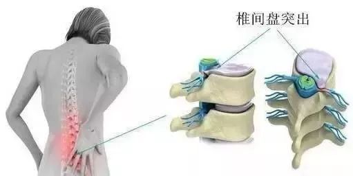 “妈妈手”，“产后腰酸背痛”，你还在忍痛吗？