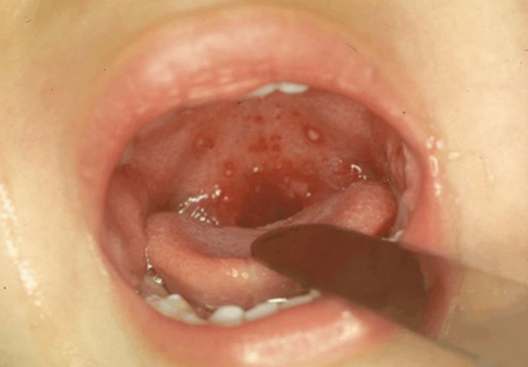 【傻傻分不清】玫瑰疹、手足口、疱疹,一篇搞定夏季“红点”症! 【傻傻分不清】玫瑰疹、手足口、疱疹,一篇搞定夏季“红点”症!