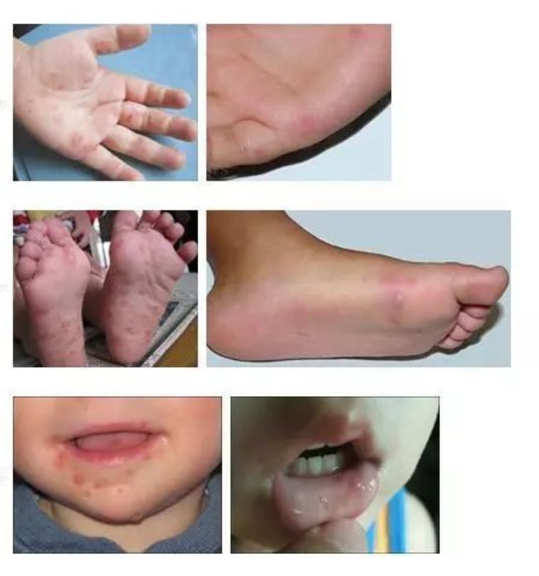 【傻傻分不清】玫瑰疹、手足口、疱疹,一篇搞定夏季“红点”症! 【傻傻分不清】玫瑰疹、手足口、疱疹,一篇搞定夏季“红点”症!