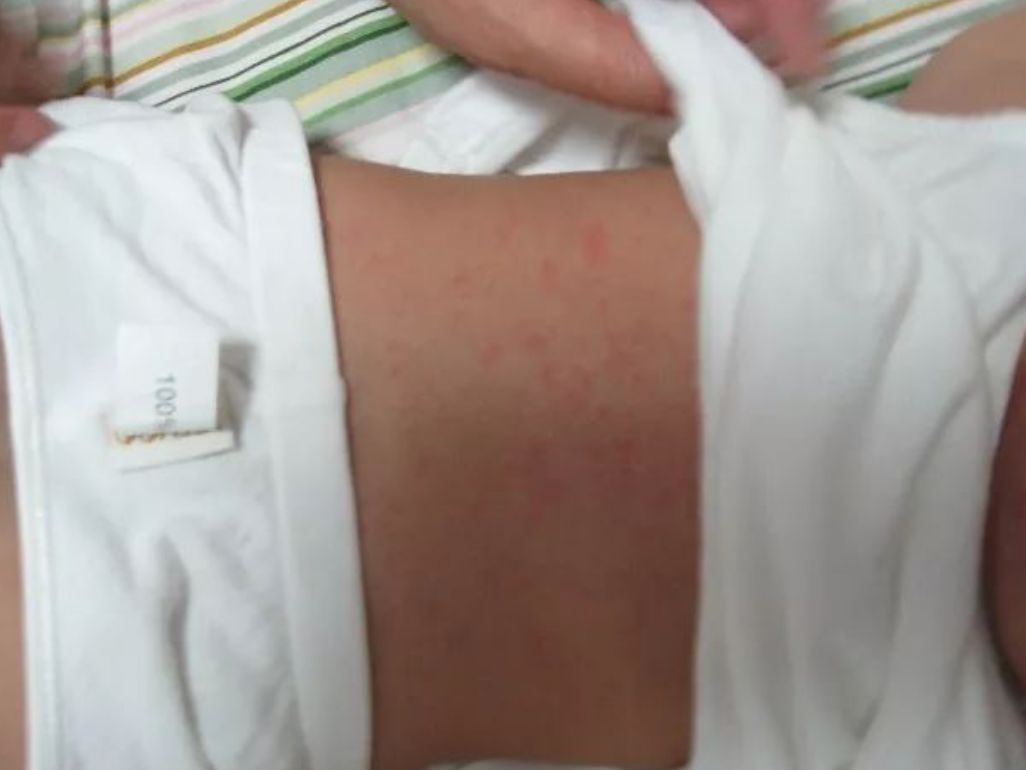 【傻傻分不清】玫瑰疹、手足口、疱疹,一篇搞定夏季“红点”症! 【傻傻分不清】玫瑰疹、手足口、疱疹,一篇搞定夏季“红点”症!