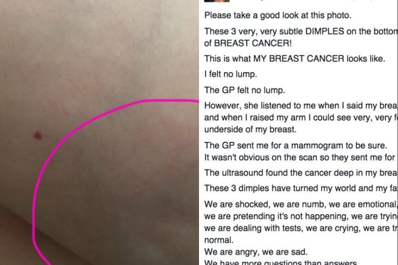脸书25万转发！胸部有这种凹陷，可能是癌症的征兆！