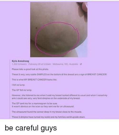 脸书25万转发！胸部有这种凹陷，可能是癌症的征兆！