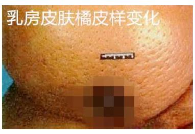 脸书25万转发！胸部有这种凹陷，可能是癌症的征兆！