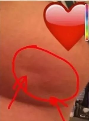 脸书25万转发！胸部有这种凹陷，可能是癌症的征兆！