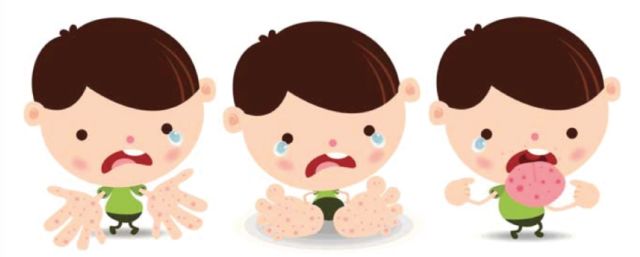 手足口竟然有后遗症！娃的指甲开始纷纷脱落....