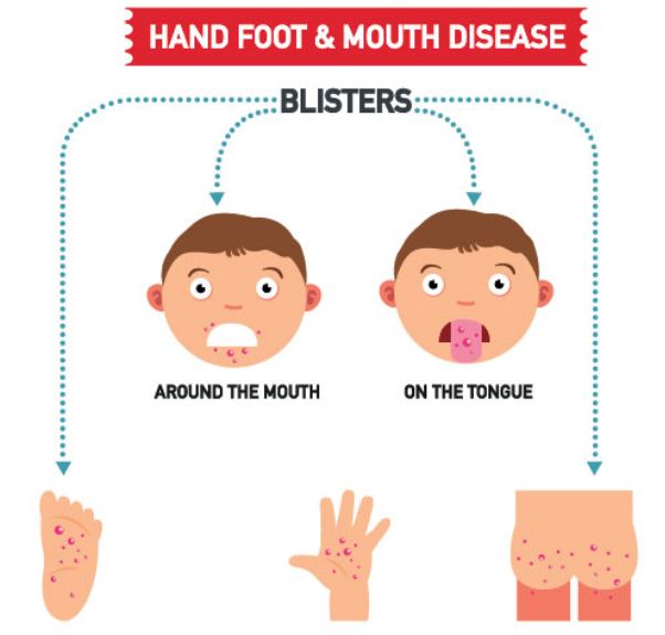 手足口竟然有后遗症！娃的指甲开始纷纷脱落....