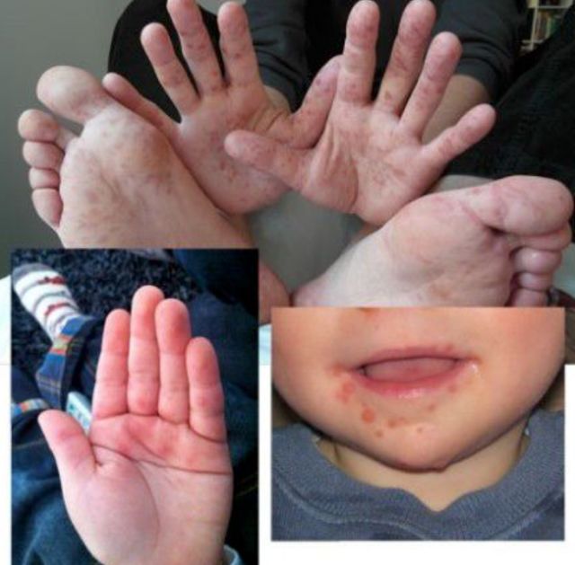 手足口竟然有后遗症！娃的指甲开始纷纷脱落....