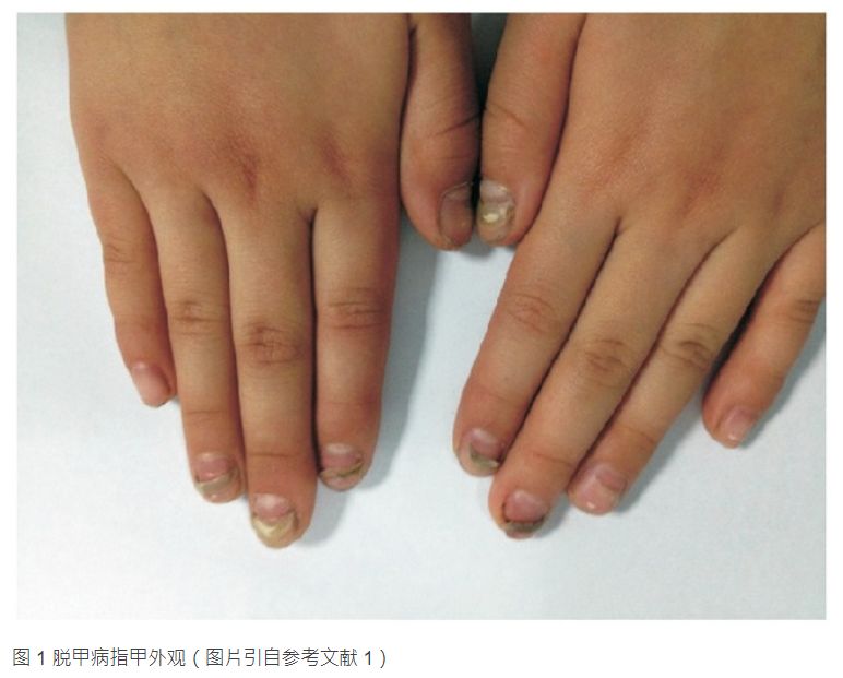 手足口竟然有后遗症！娃的指甲开始纷纷脱落....