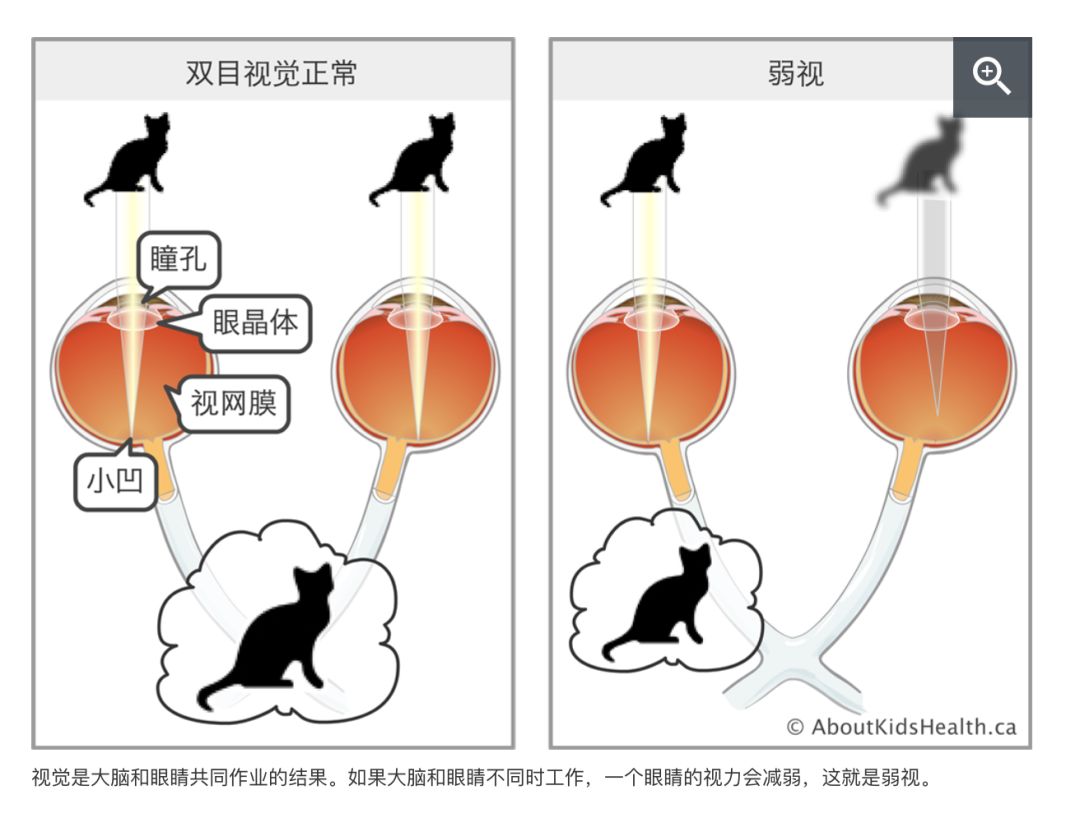 实访眼科医生:答疑妈妈最爱问的孩子眼科话题 实访眼科医生:答疑妈妈最爱问的孩子眼科话题
