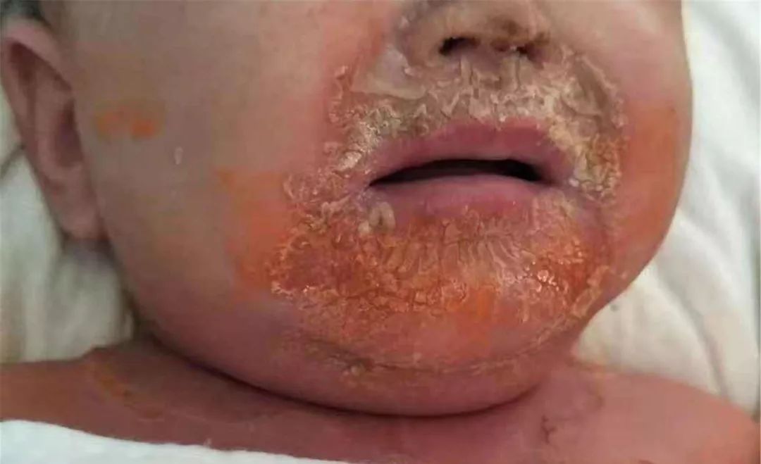 1岁宝宝全身的皮肤一碰就掉……医生诊断其感染了这种细菌