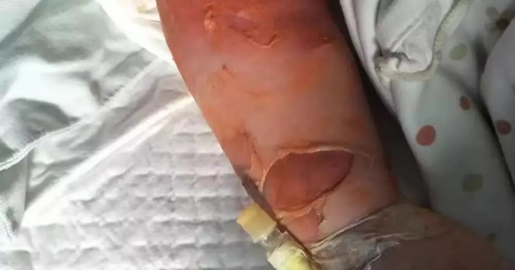1岁宝宝全身的皮肤一碰就掉……医生诊断其感染了这种细菌