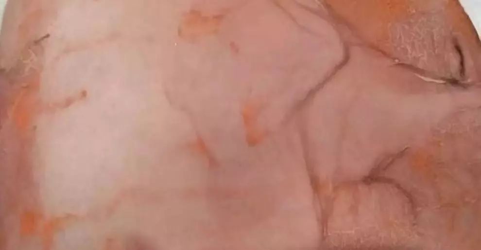 1岁宝宝全身的皮肤一碰就掉……医生诊断其感染了这种细菌