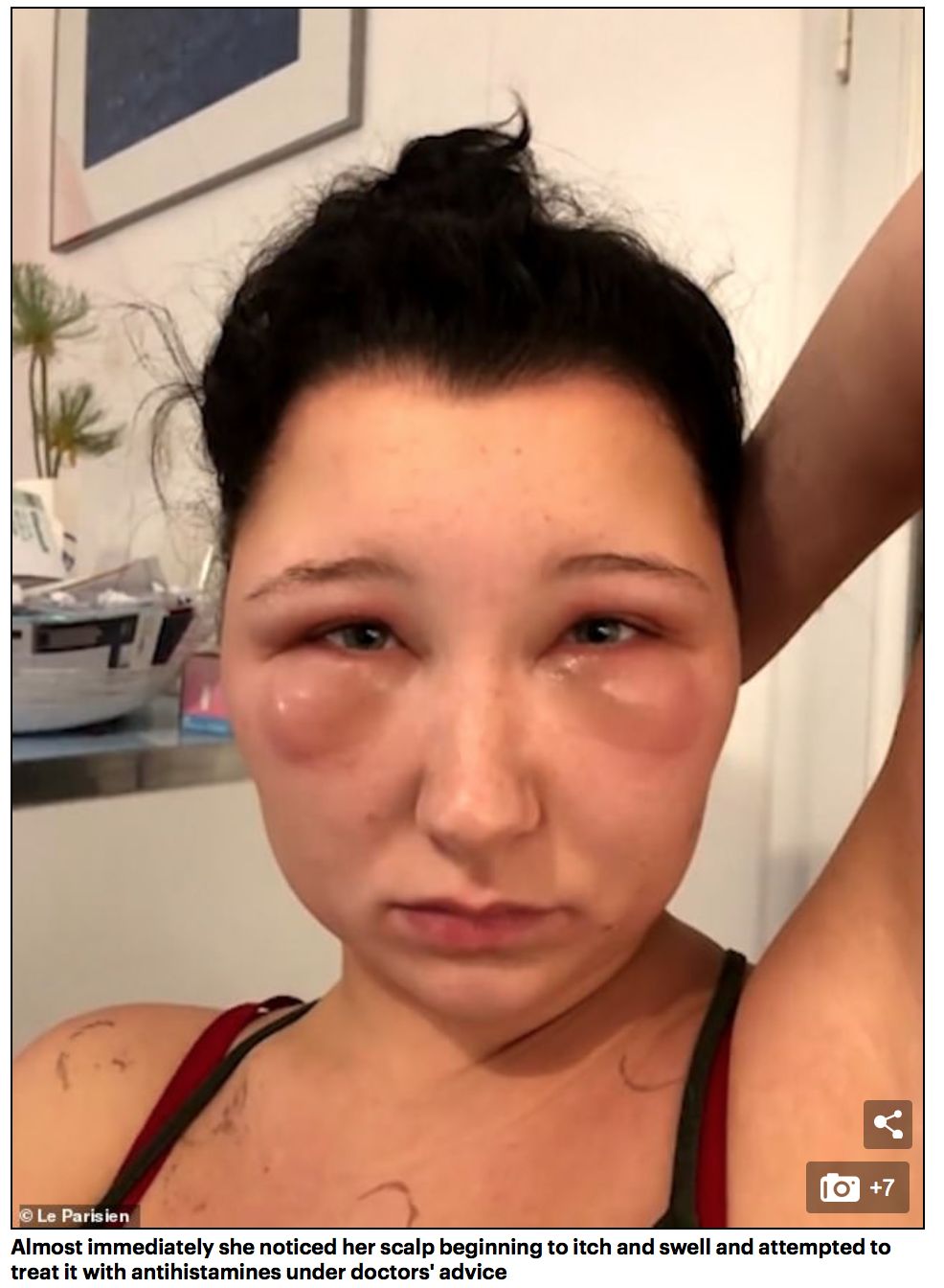 妹子自己在家染发,脑袋肿成了外星人..... 妹子自己在家染发,脑袋肿成了外星人.....