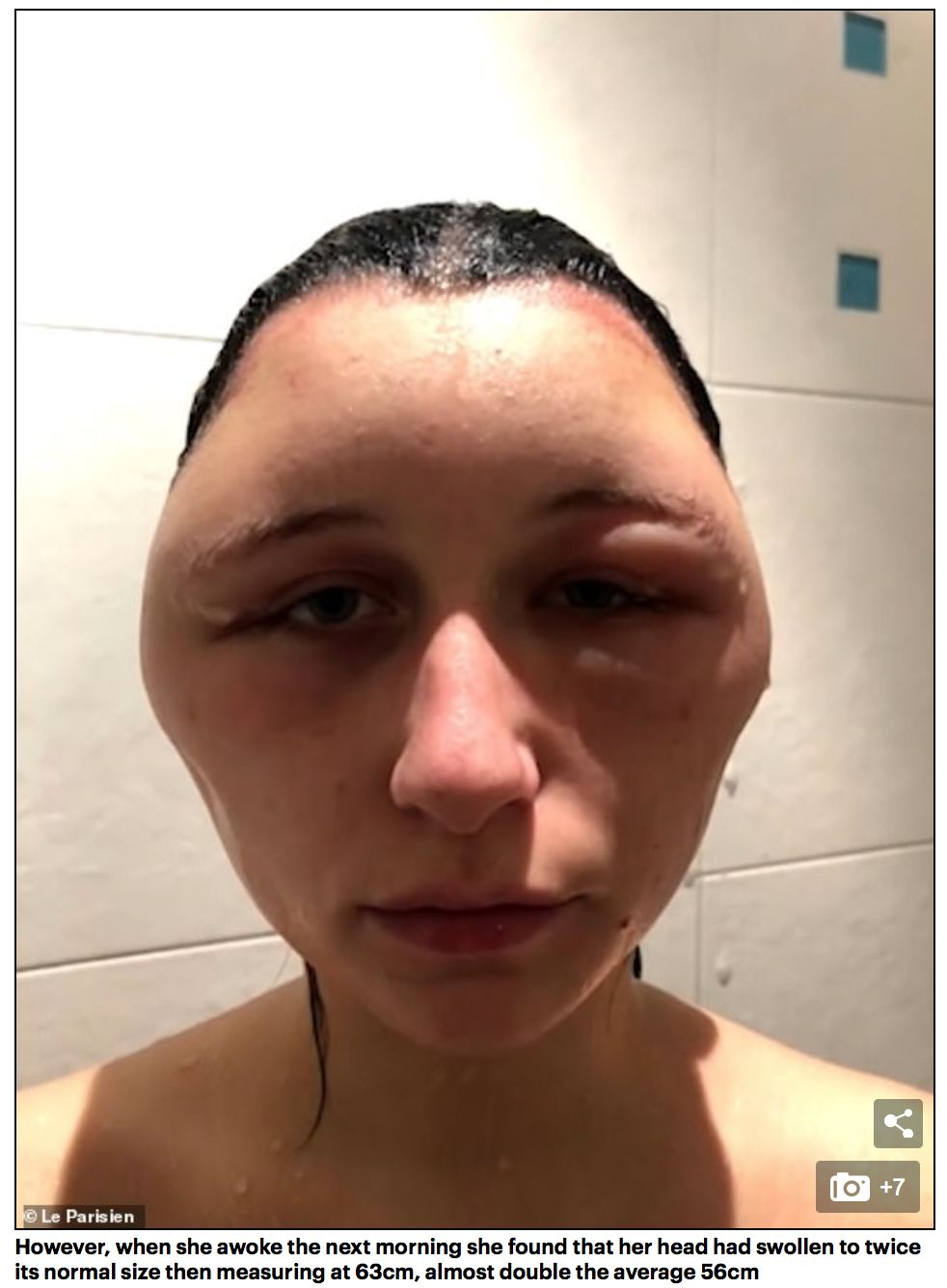 妹子自己在家染发,脑袋肿成了外星人..... 妹子自己在家染发,脑袋肿成了外星人.....