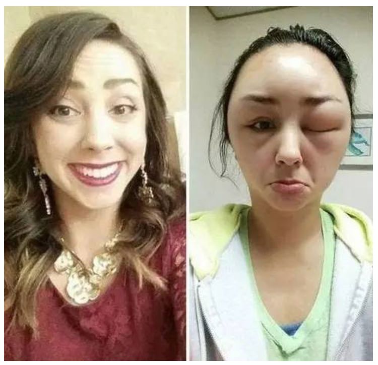 妹子自己在家染发,脑袋肿成了外星人..... 妹子自己在家染发,脑袋肿成了外星人.....