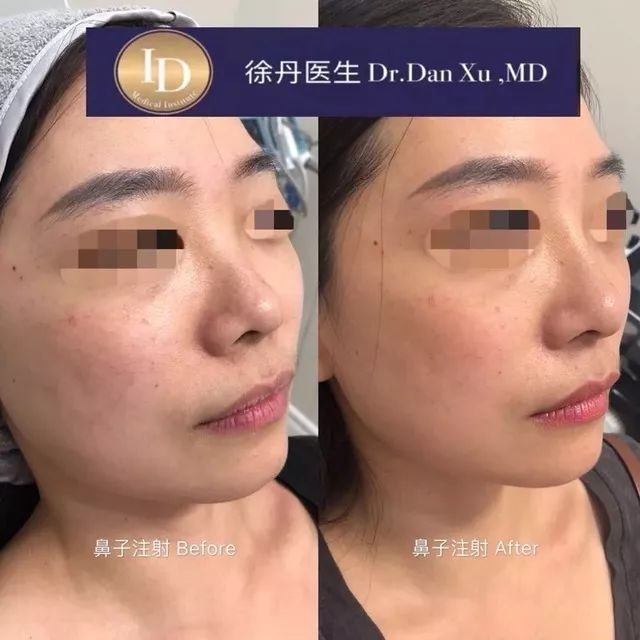 打玻尿酸=整容？听听加拿大医生怎么说...