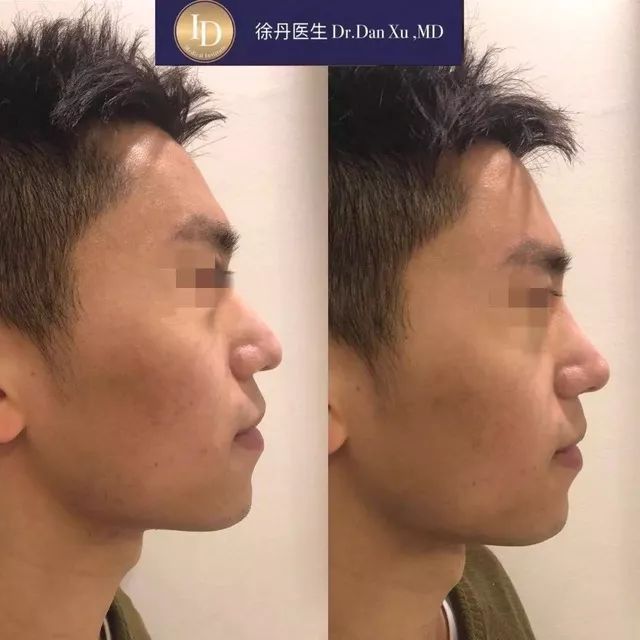 打玻尿酸=整容？听听加拿大医生怎么说...