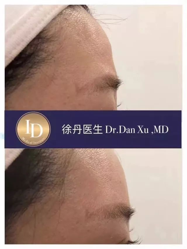 打玻尿酸=整容？听听加拿大医生怎么说...