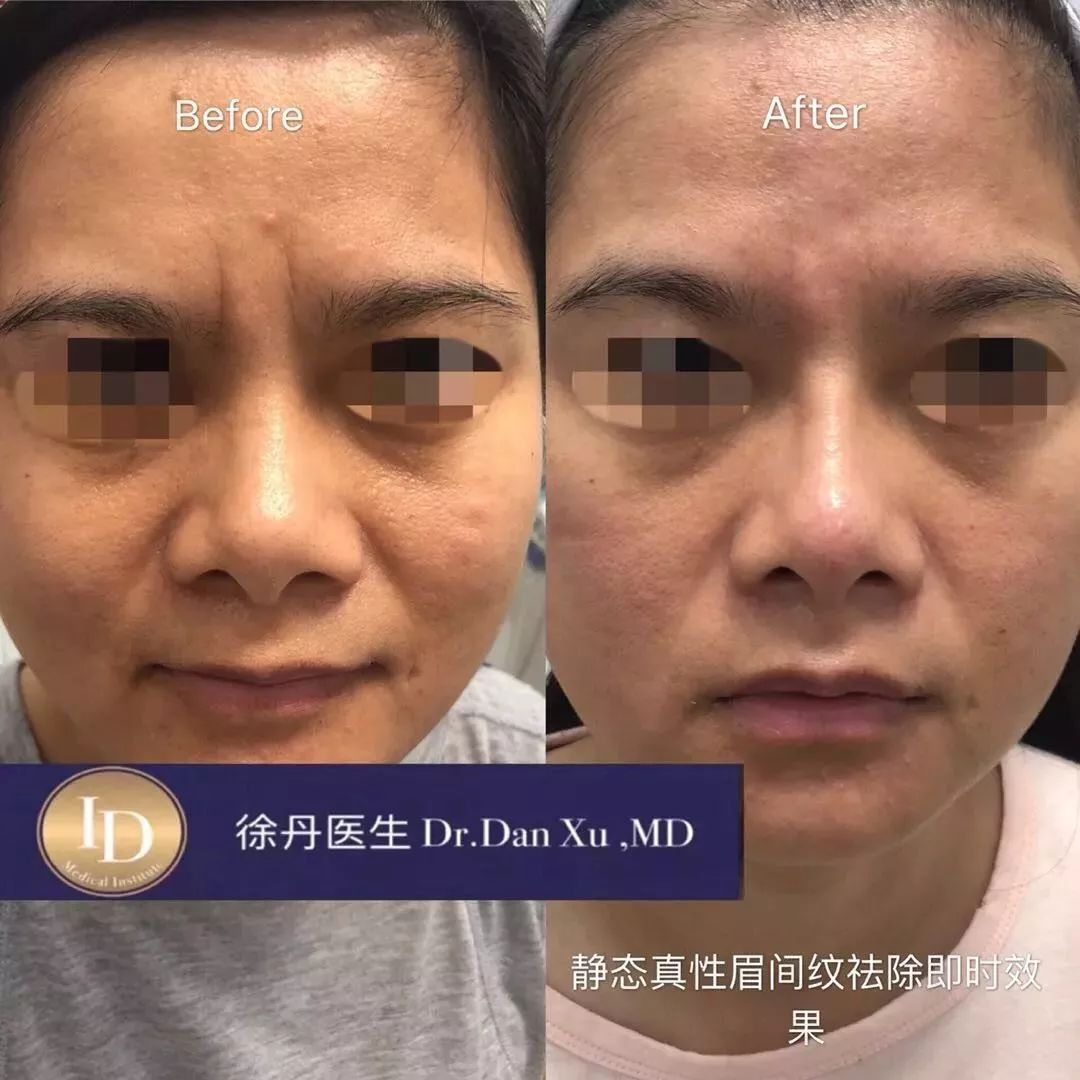 打玻尿酸=整容？听听加拿大医生怎么说...