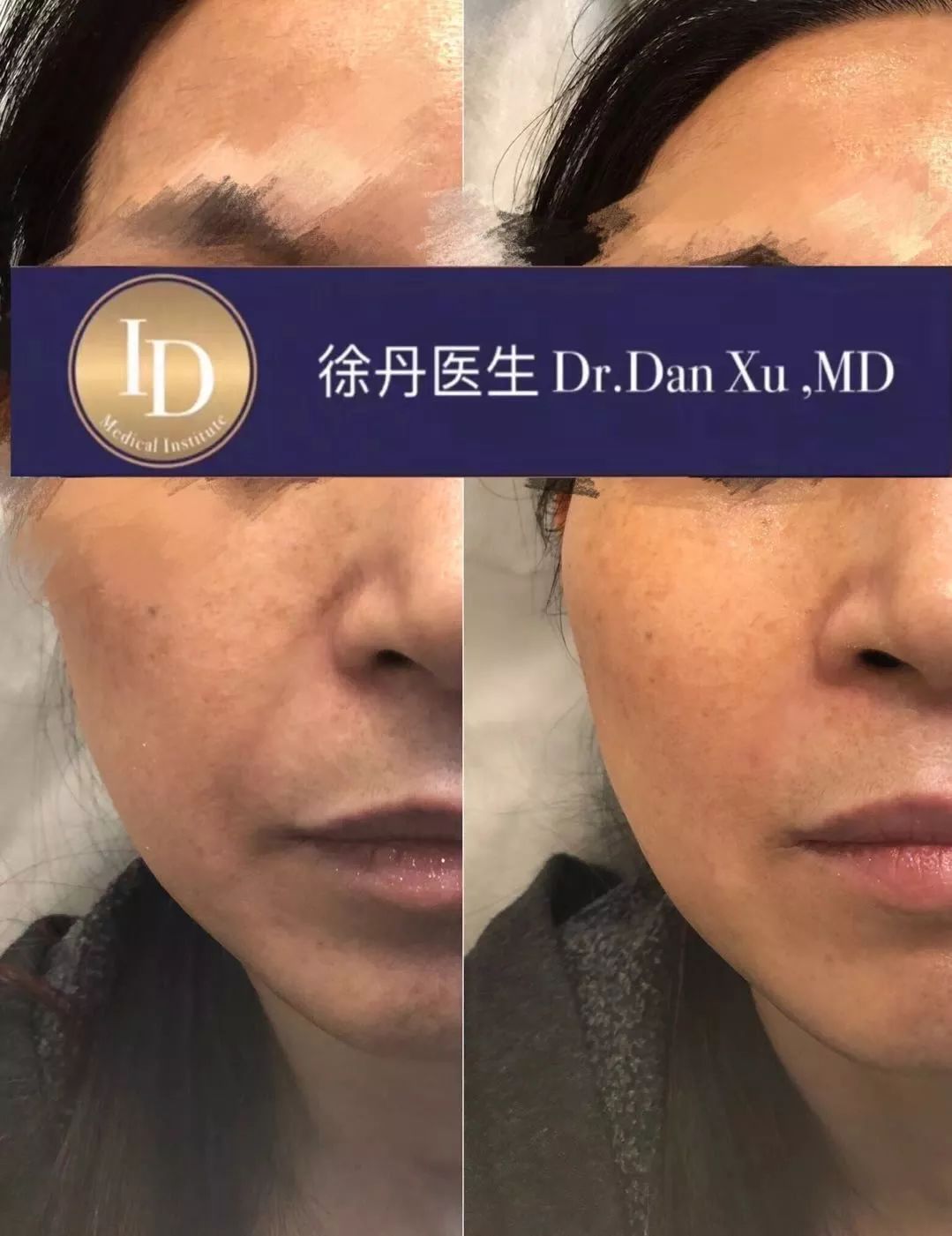 打玻尿酸=整容？听听加拿大医生怎么说...