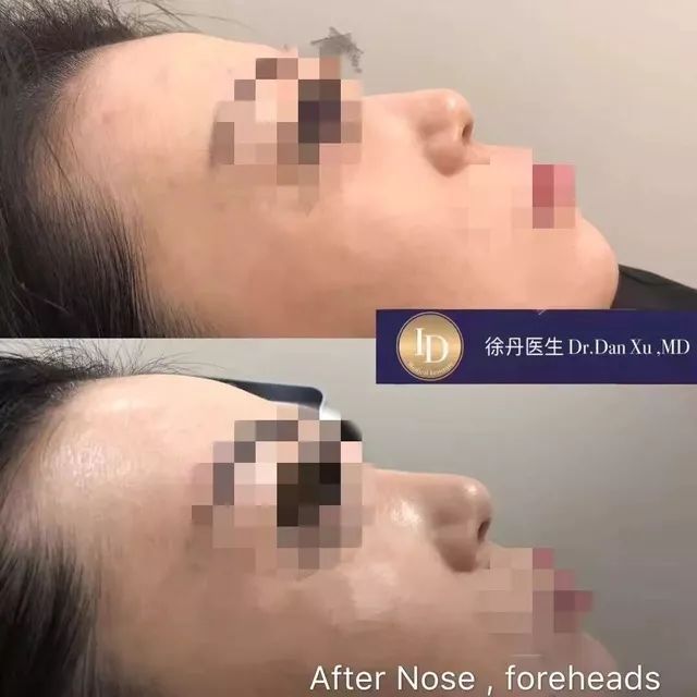 打玻尿酸=整容？听听加拿大医生怎么说...