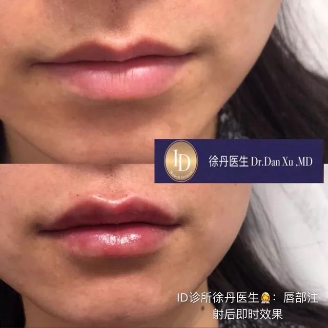 打玻尿酸=整容？听听加拿大医生怎么说...