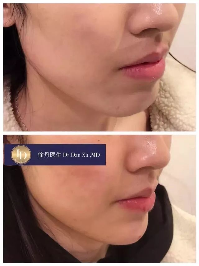 打玻尿酸=整容？听听加拿大医生怎么说...