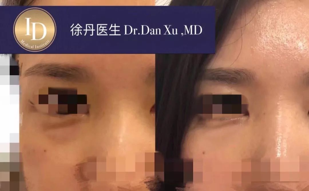 打玻尿酸=整容？听听加拿大医生怎么说...