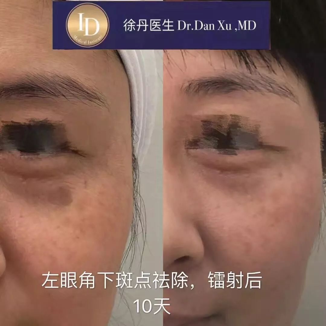 打玻尿酸=整容？听听加拿大医生怎么说...