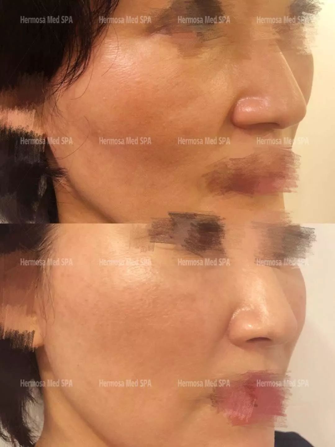 VOUGE话题:月花2000买护肤品vs日用大宝做医美,选哪个? VOUGE话题:月花2000买护肤品vs日用大宝做医美,选哪个?