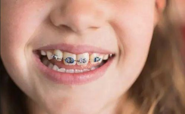 孩子可以免费矫正牙齿？这个福利你要了解一下！