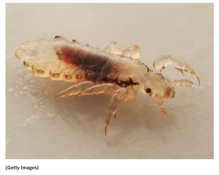 又闹虱子！还是变异的！长过虱子的娃更容易被传染！！