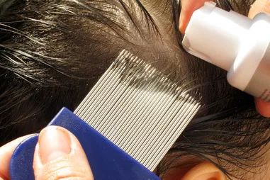 又闹虱子！还是变异的！长过虱子的娃更容易被传染！！