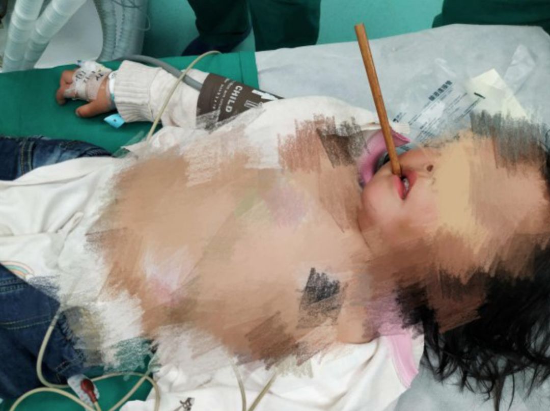 3岁孩子拿着筷子乱跑跌倒，筷子插入颅内10厘米......