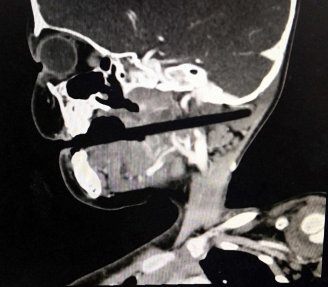 3岁孩子拿着筷子乱跑跌倒，筷子插入颅内10厘米......