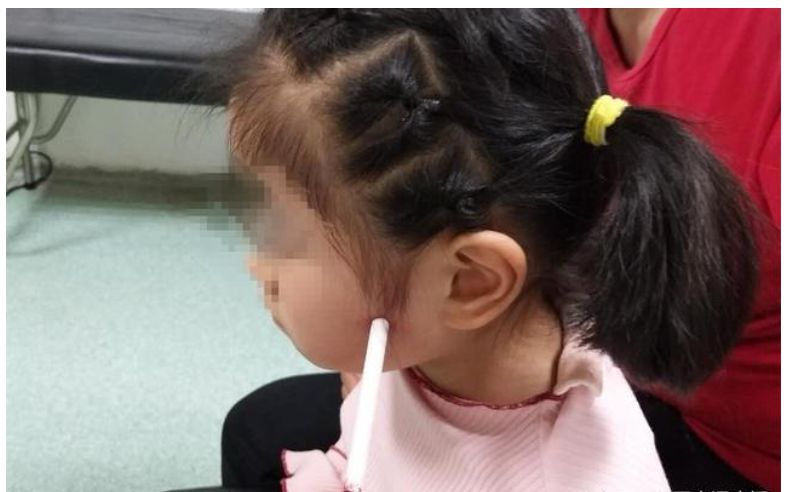 3岁孩子拿着筷子乱跑跌倒，筷子插入颅内10厘米......