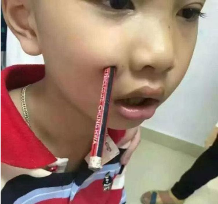 3岁孩子拿着筷子乱跑跌倒，筷子插入颅内10厘米......