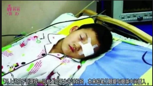 3岁孩子拿着筷子乱跑跌倒，筷子插入颅内10厘米......