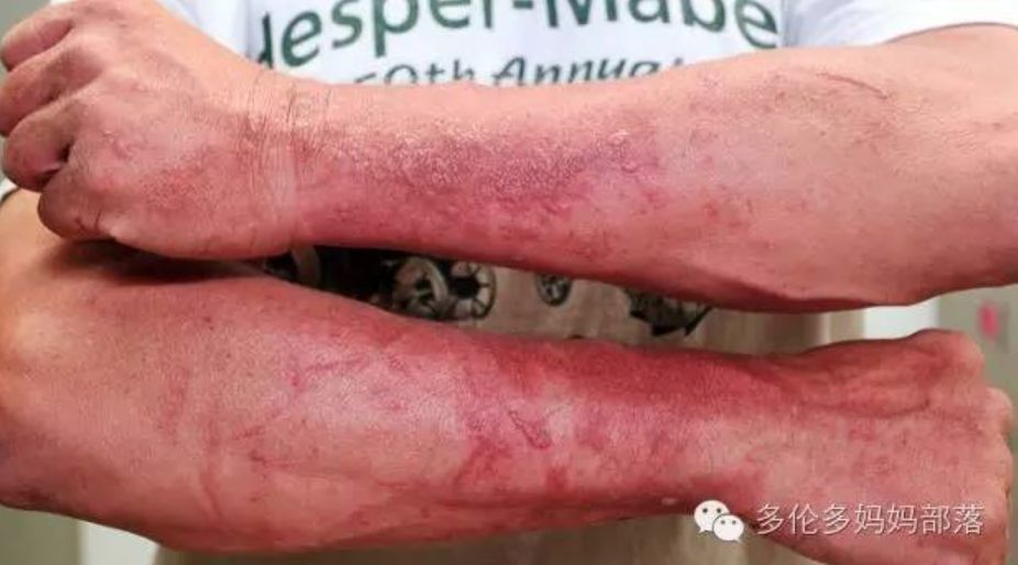 有毒！越不起眼越有毒！多伦多这些常见的花花草草千万别让孩子碰！