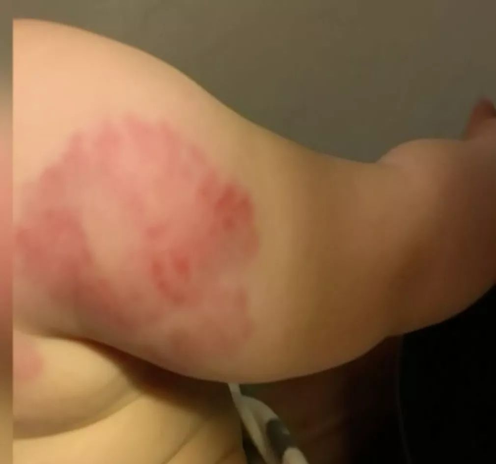 娃上Daycare竟然被人咬了25次,后背全是牙印... 娃上Daycare竟然被人咬了25次,后背全是牙印...