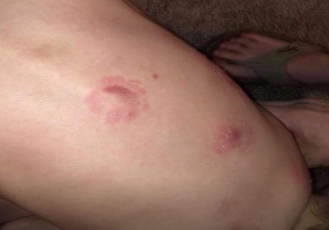 娃上Daycare竟然被人咬了25次,后背全是牙印... 娃上Daycare竟然被人咬了25次,后背全是牙印...