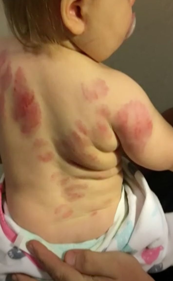 娃上Daycare竟然被人咬了25次,后背全是牙印... 娃上Daycare竟然被人咬了25次,后背全是牙印...