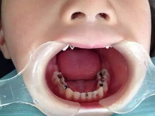 宝宝长蛀牙症状图片图片