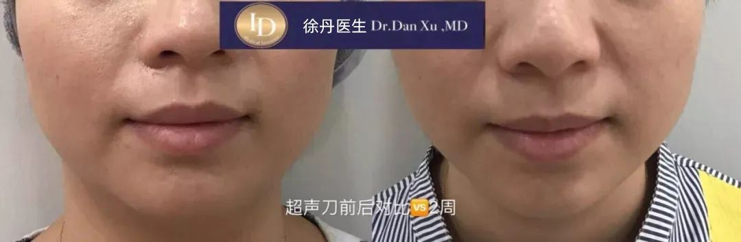 前后变化有多大?自己看吧,口碑推荐,我夸累了! 前后变化有多大?自己看吧,口碑推荐,我夸累了!